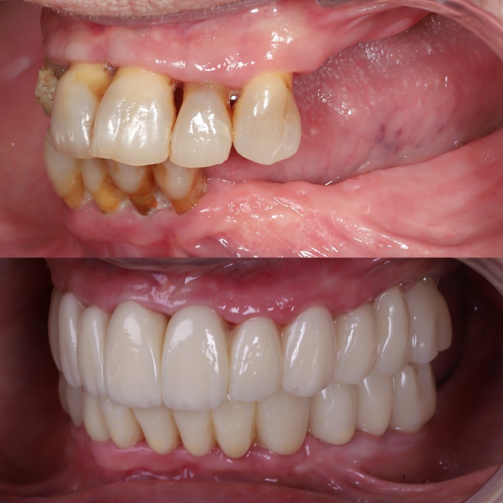 implantes dentales sin tornillos