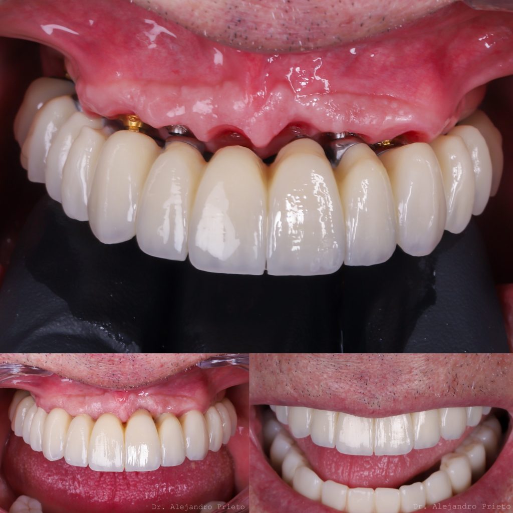 Dentadura fija completa en el día