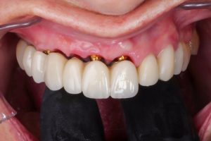 cirugía dental para implantes explicación