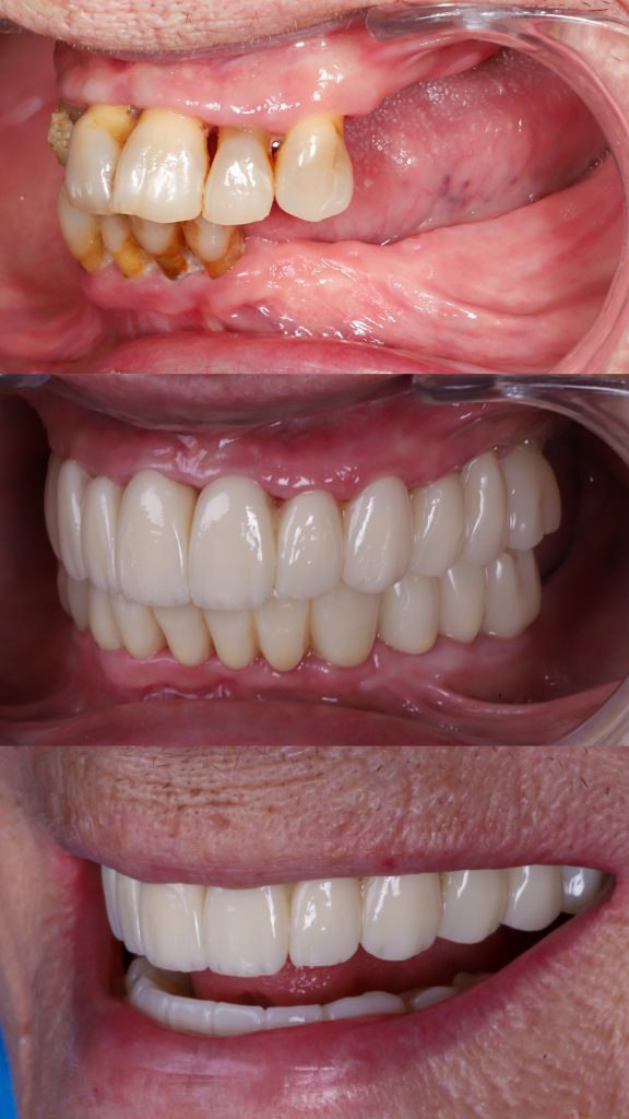 implantes dentales en madrid pacientes sin hueso