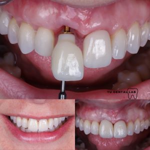 proceso y tiempo colocaci&oacute;n de un implante dental