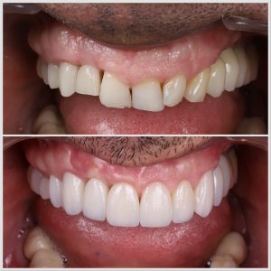 Before and after photos of dental veneers in Madrid