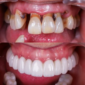 implantes dentales en madrid