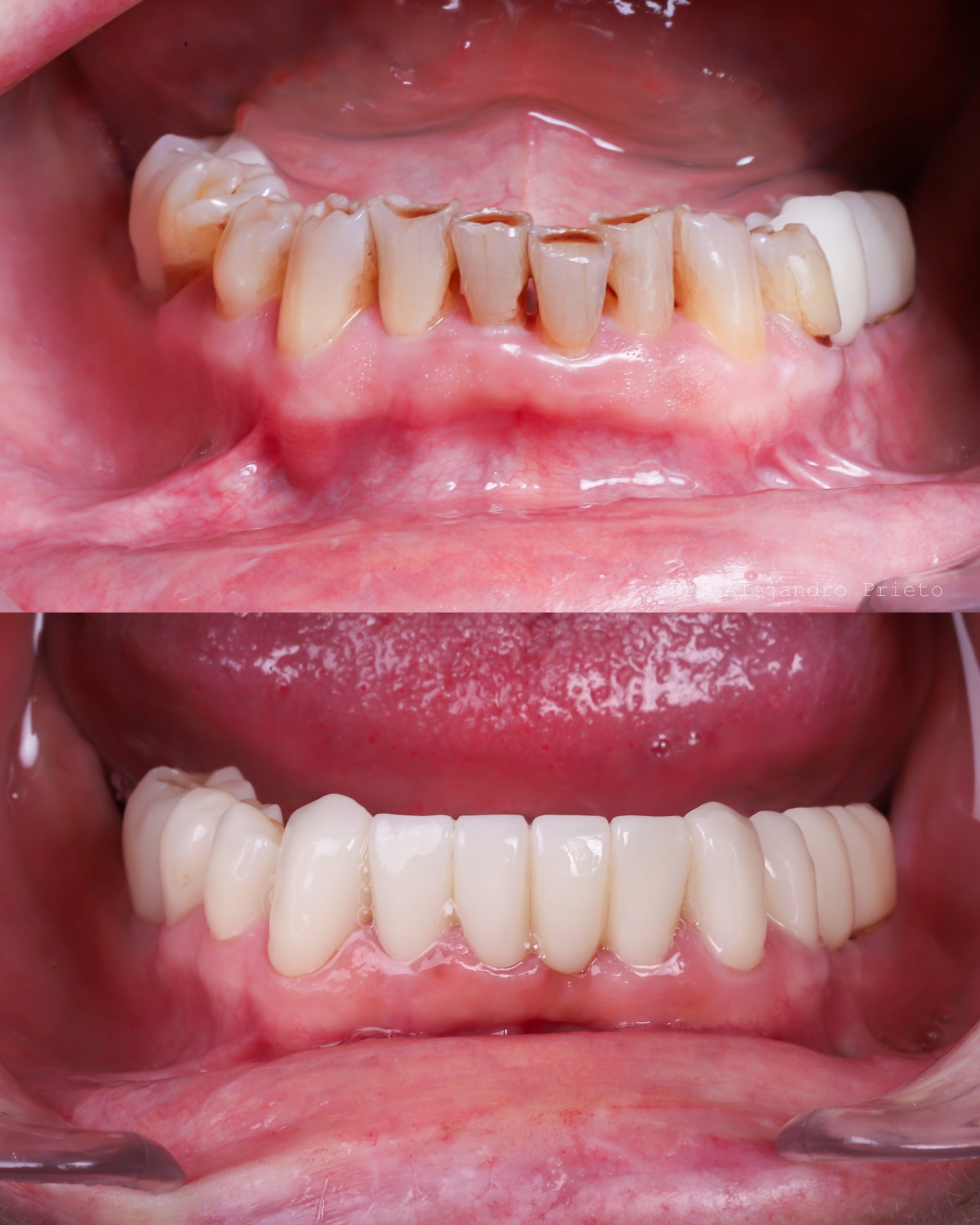 Restauración completa de la dentadura inferior: antes y después.