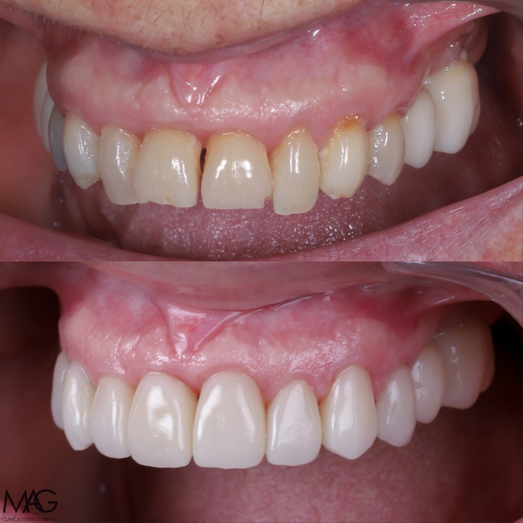 fotos carillas de porcelana, resultado natural a diferencia de las carillas de composite