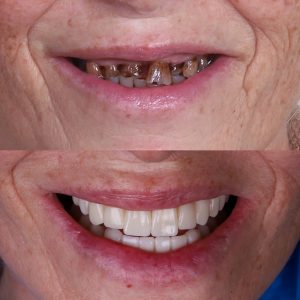 precio implantes dentales 2025