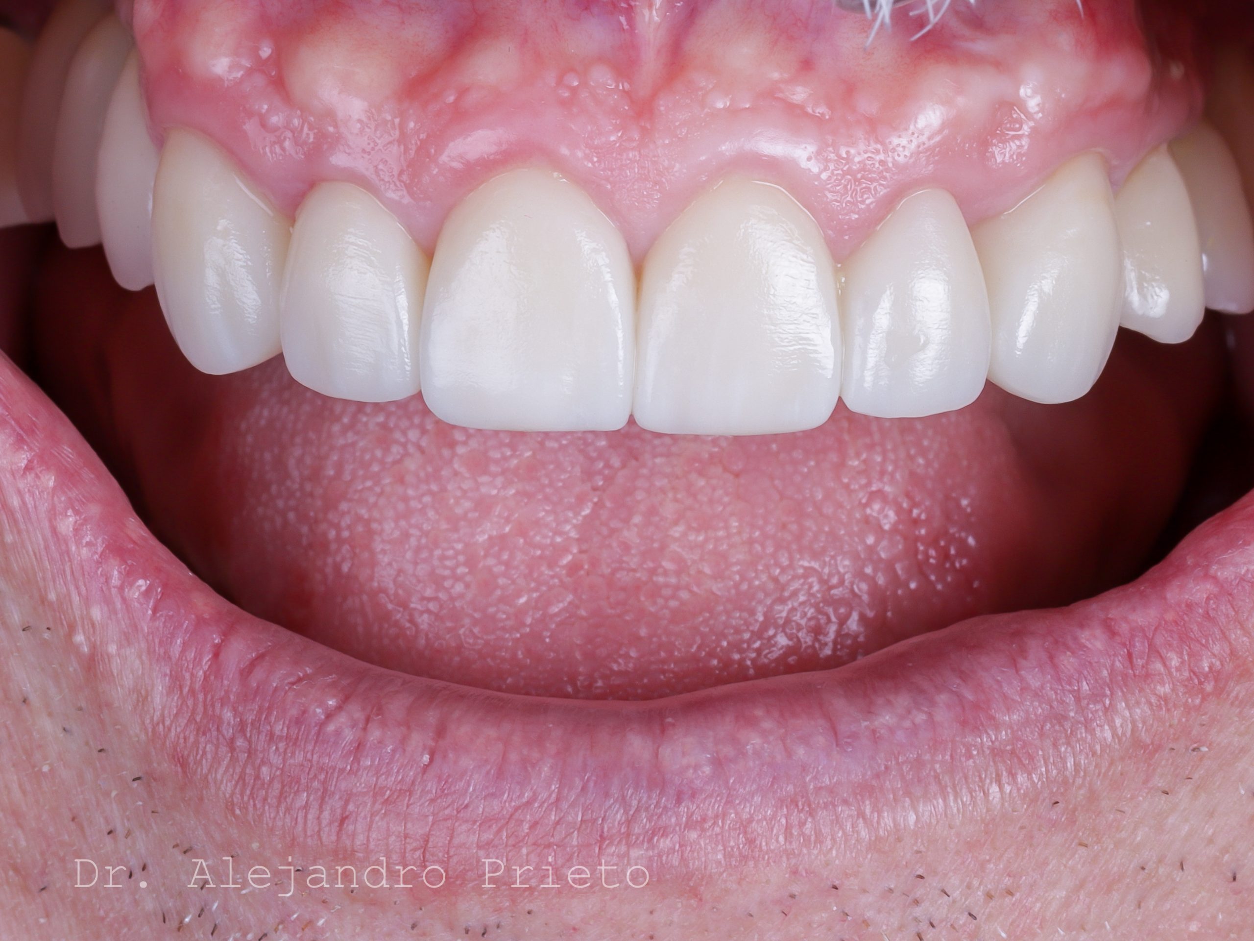 Sonrisa saludable con dientes blancos y encías rosadas.