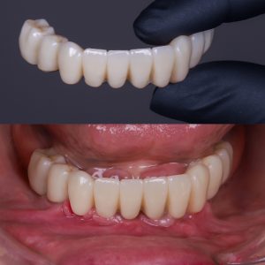 antes y después implantes dentales en Madrid