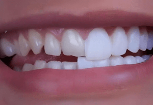 foto de carillas de composite