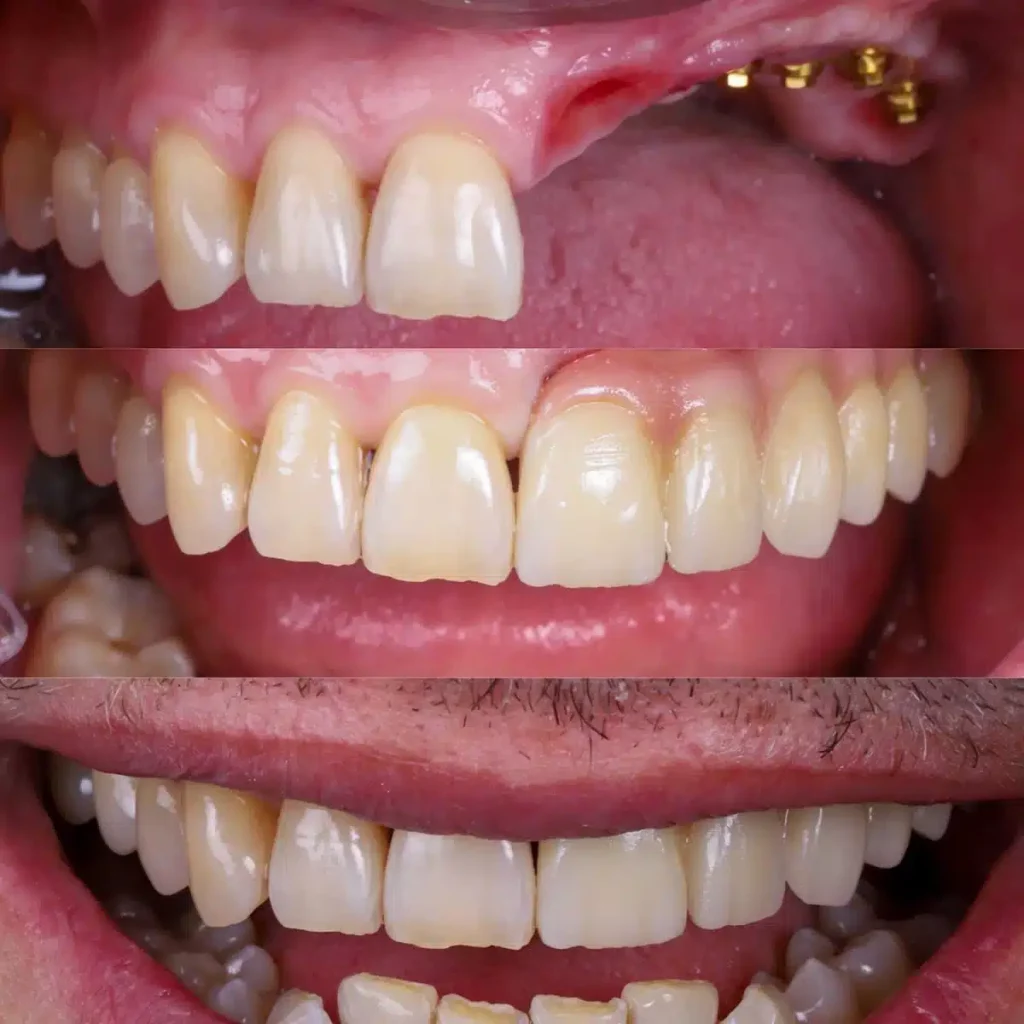 caso de infección de implantes donde quitamos y reemplazamos con regeneración de hueso