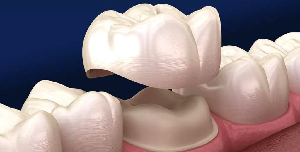 qué es una corona dental