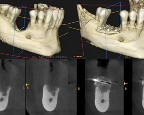 Escaneo 3D de planificación de implantes dentales