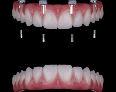 Prótesis dental sobre implantes modelo