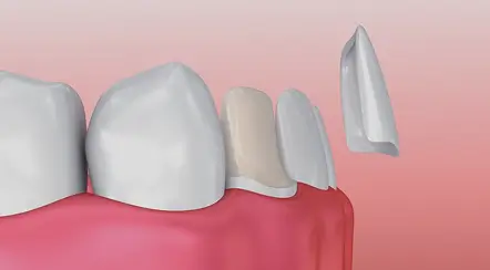 Mostrando un diente roto