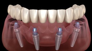 implantes para dentadura postiza
