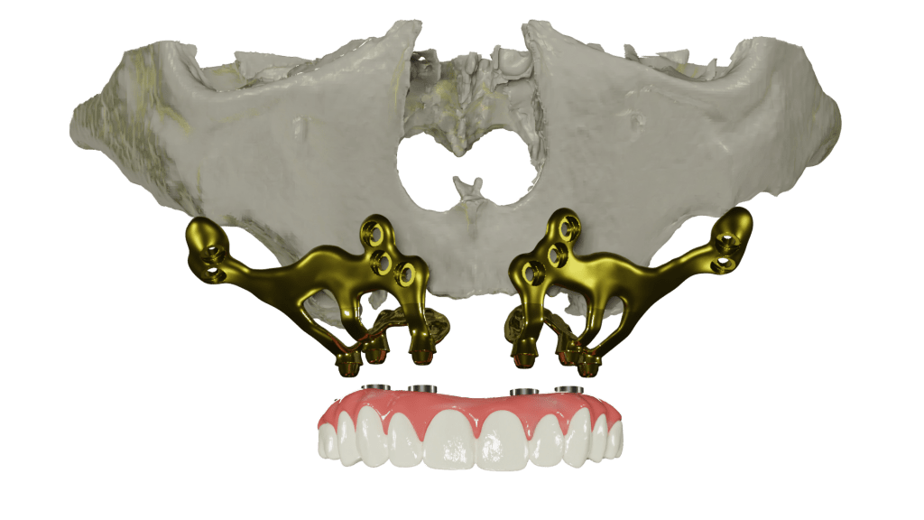 tipos de implantes dentales, implantes yuxtaóseos