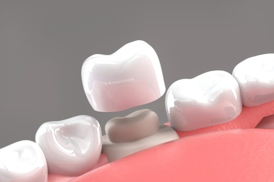 precio corona dental en Madrid