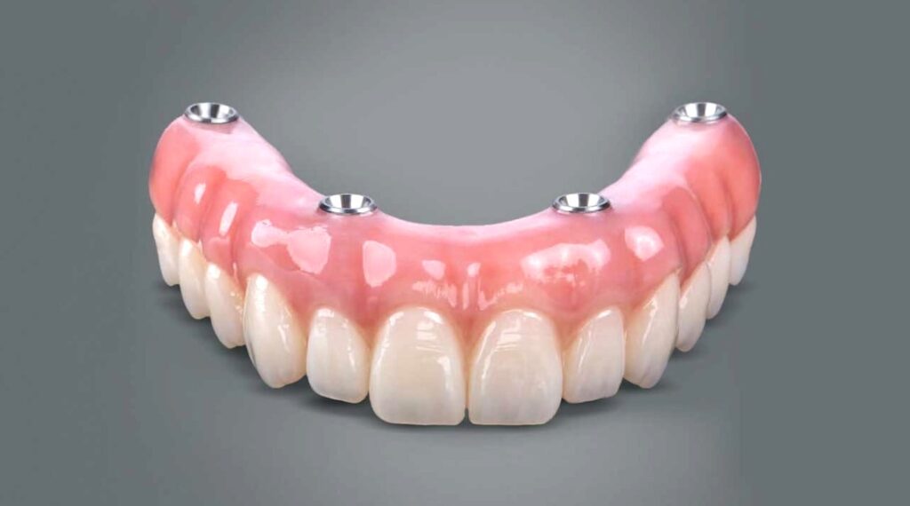 Prótesis dental completa superior anclada con cuatro implantes.