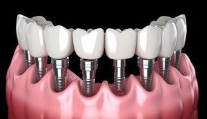 dental implant removal price