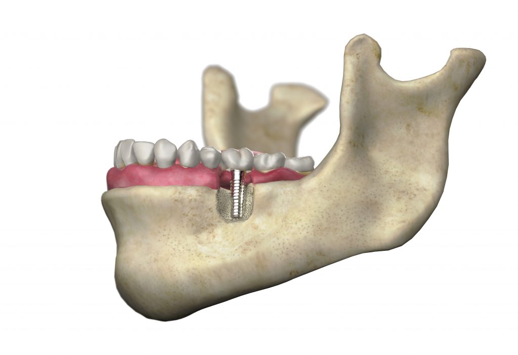 tipos de implantes dentales, implantes endoóseos