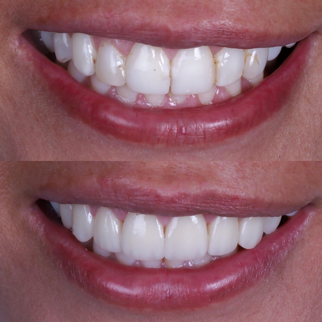 antes y después de carillas de porcelana proceso paso a paso