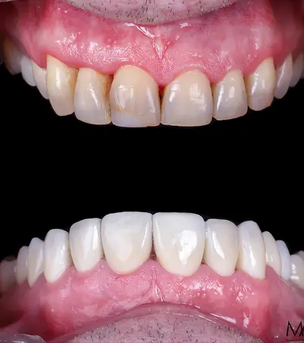 fotos de antes y después de carillas dentales