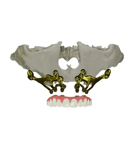 implantes subperiósticos o implantes sin tornillos para pacientes con falta de hueso