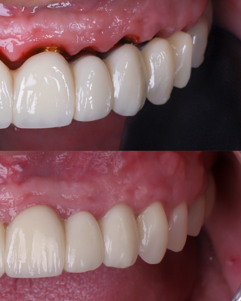 dentadura fija sobre implantes dentales