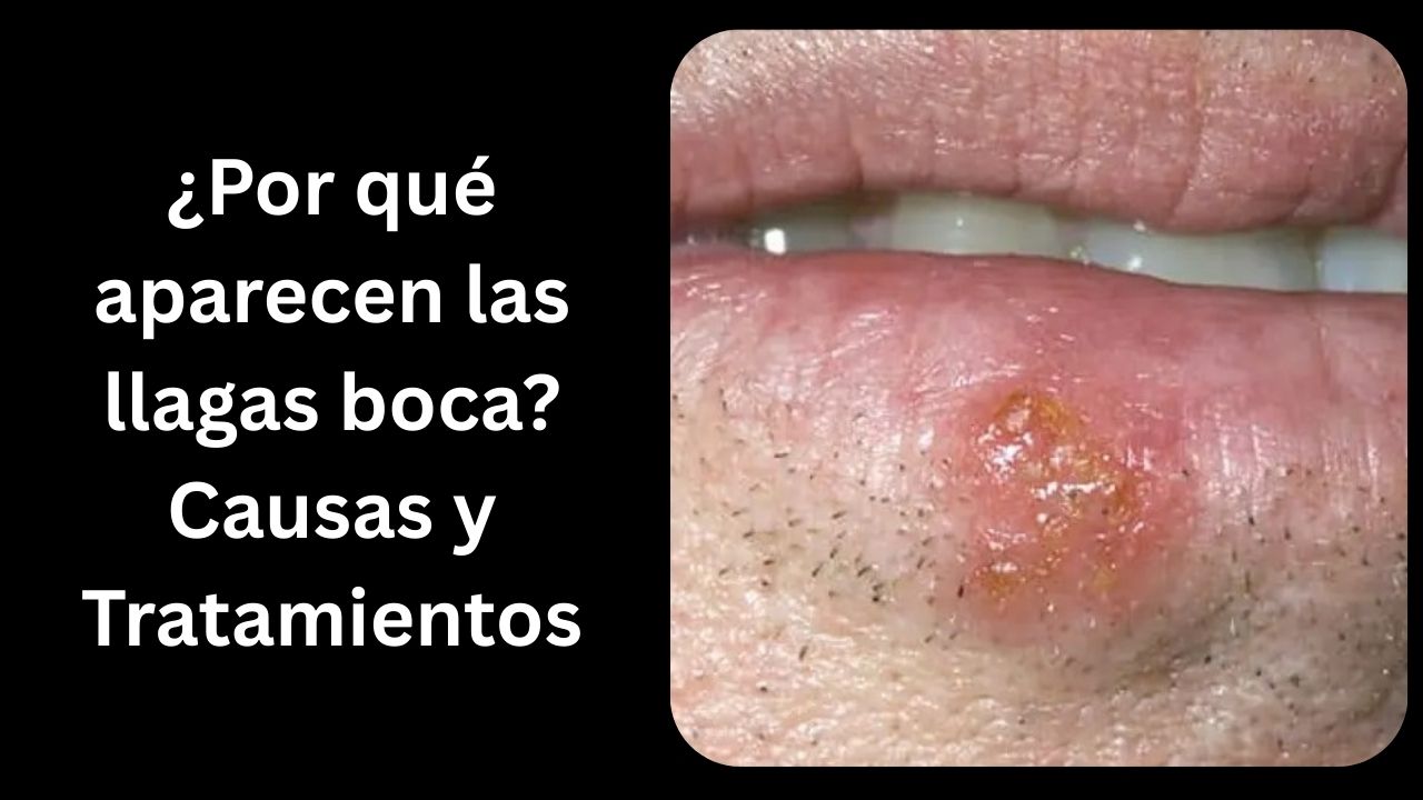 Imagen en primer plano de un labio con una llaga o ampolla visible, potencialmente causada por infección viral o irritación.